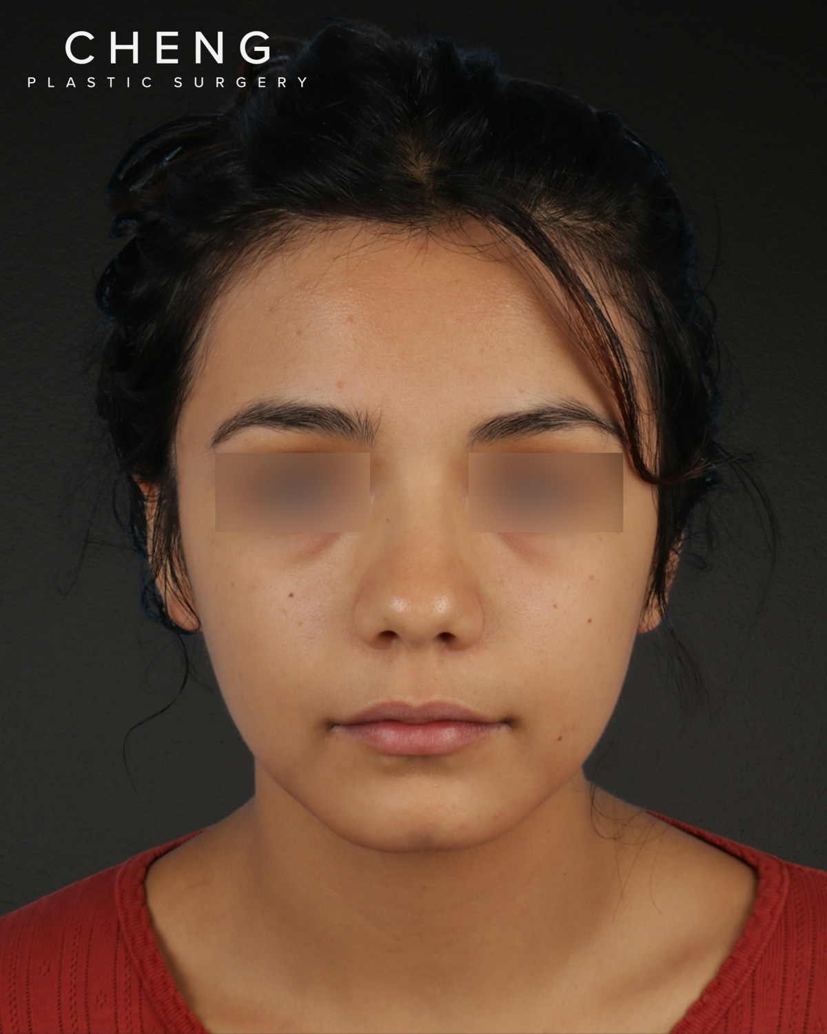Rhinoplasty Before & After Gallery - Patient 342648 - Image 5