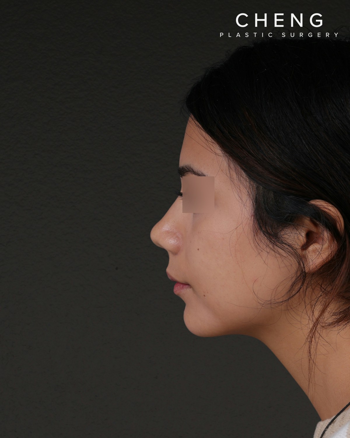Rhinoplasty Before & After Gallery - Patient 342648 - Image 4