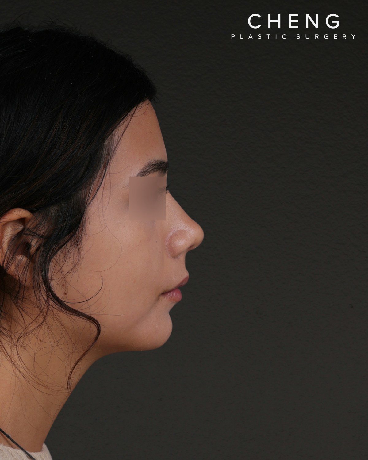 Rhinoplasty Before & After Gallery - Patient 342648 - Image 2