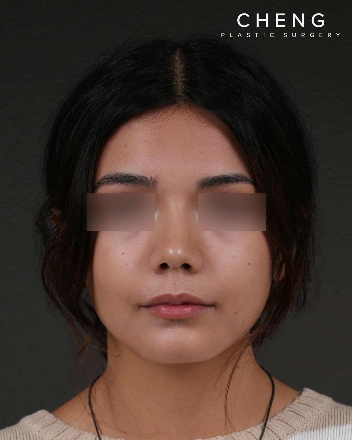 Rhinoplasty Before & After Gallery - Patient 342648 - Image 6