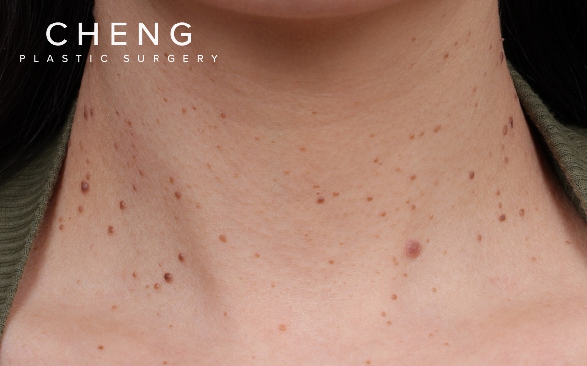 BBL Laser Before & After Gallery - Patient 949626 - Image 1