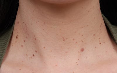 BBL Laser Before & After Gallery - Patient 949626 - Image 1