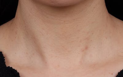 BBL Laser Before & After Gallery - Patient 949626 - Image 2