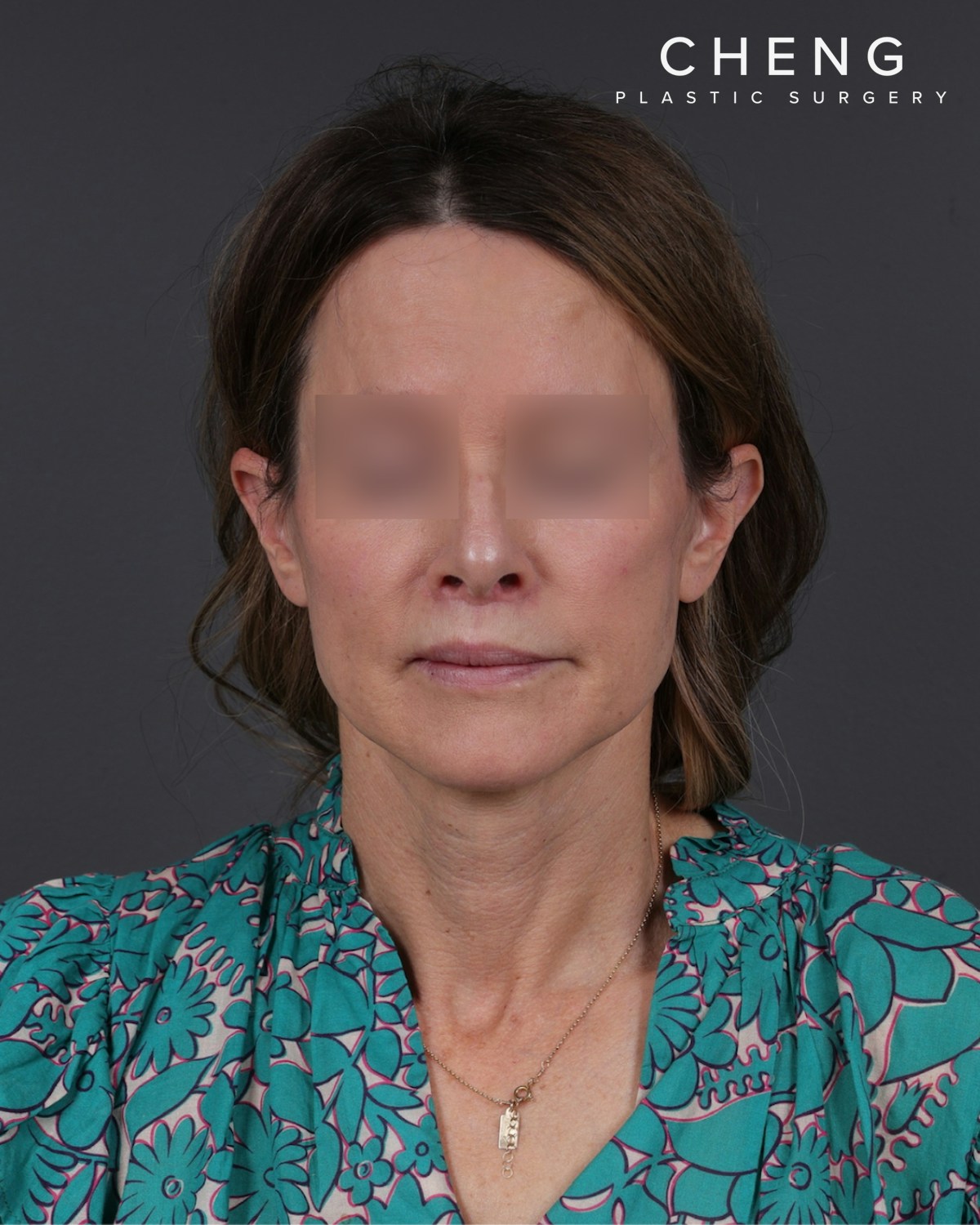 Neck Lift Before & After Gallery - Patient 260602 - Image 2