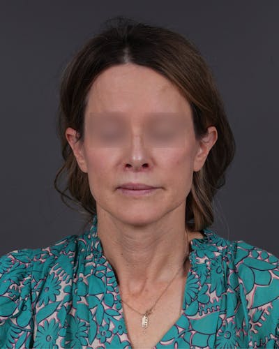 Neck Lift Before & After Gallery - Patient 260602 - Image 2
