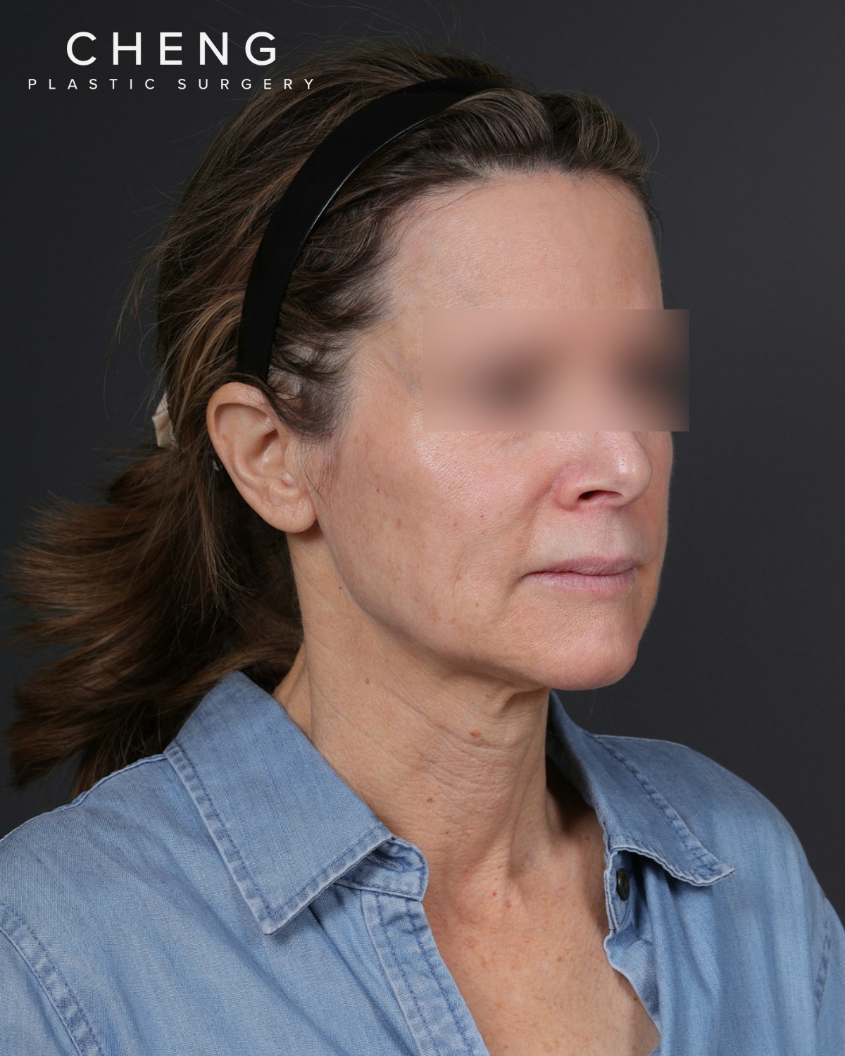 Neck Lift Before & After Gallery - Patient 260602 - Image 3