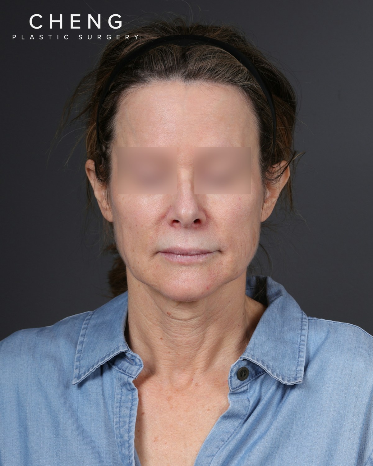Neck Lift Before & After Gallery - Patient 260602 - Image 1