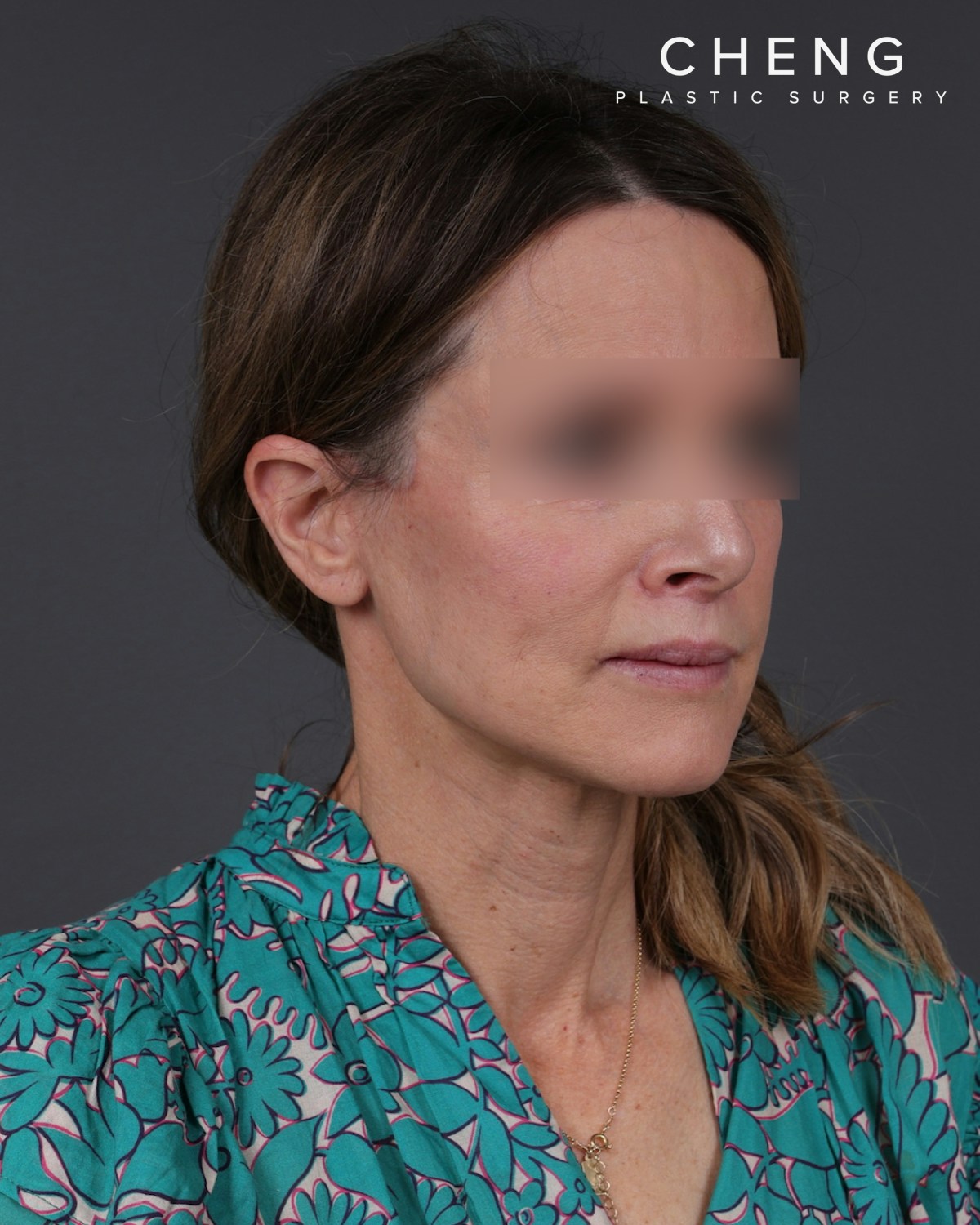 Neck Lift Before & After Gallery - Patient 260602 - Image 4