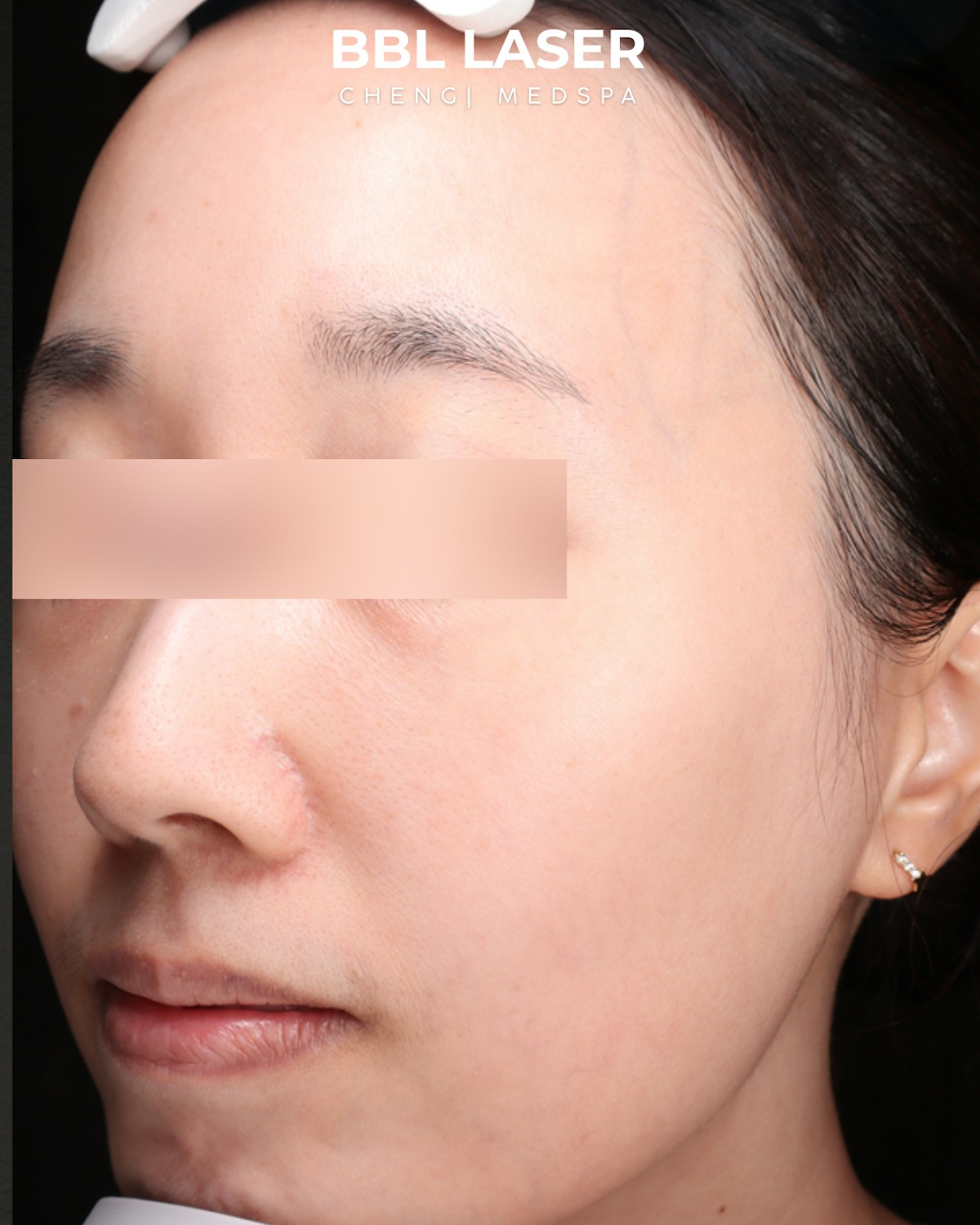 BBL Laser Before & After Gallery - Patient 157854 - Image 6