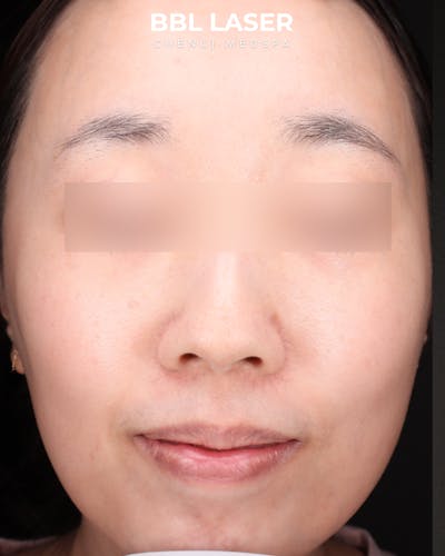 BBL Laser Before & After Gallery - Patient 157854 - Image 2