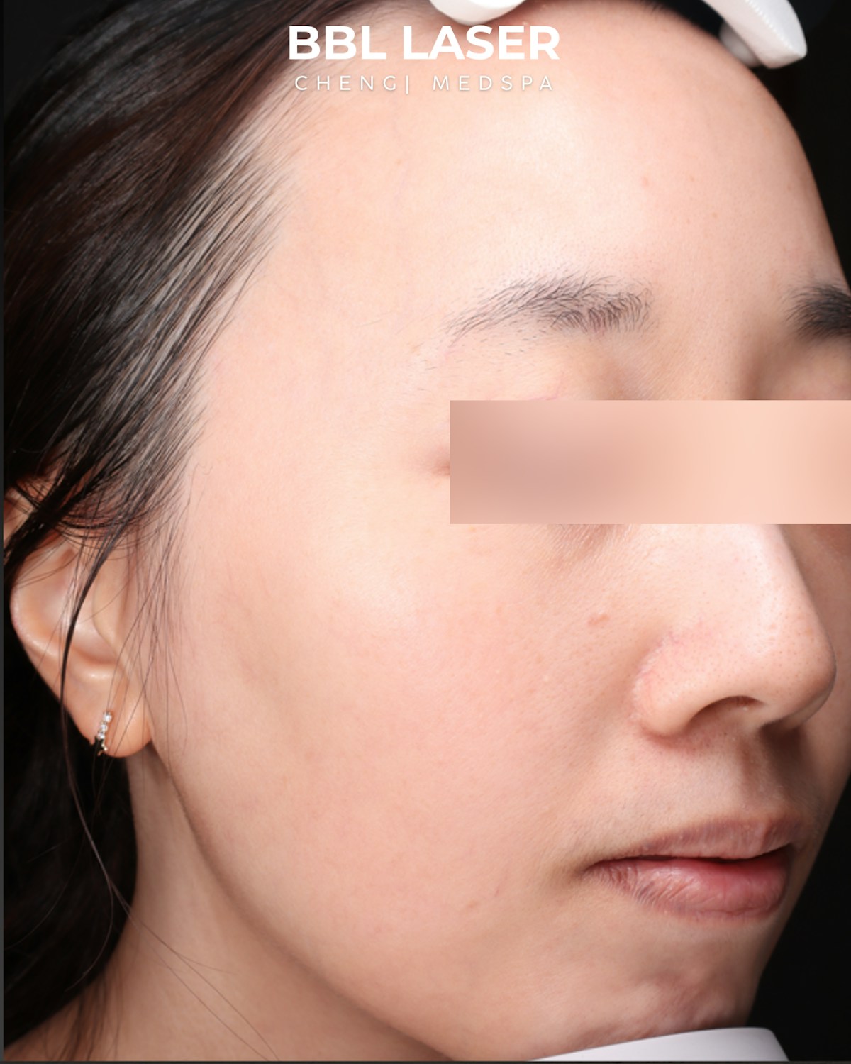 BBL Laser Before & After Gallery - Patient 157854 - Image 4