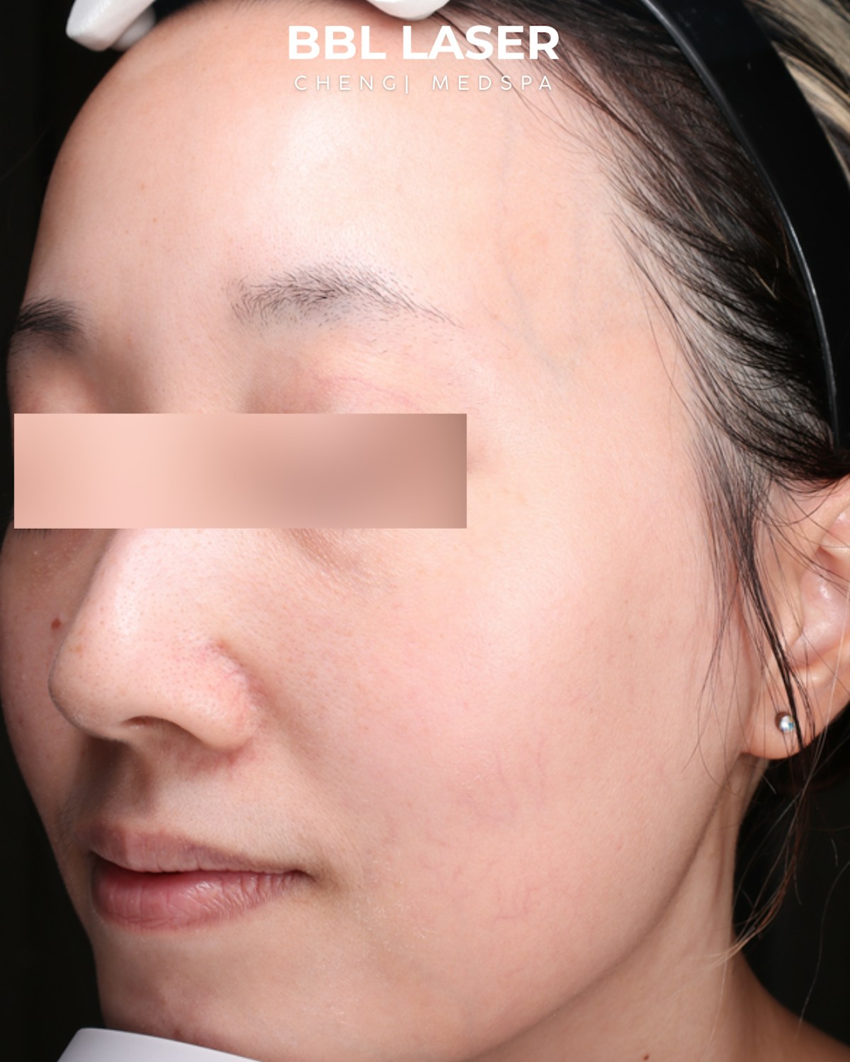 BBL Laser Before & After Gallery - Patient 157854 - Image 5