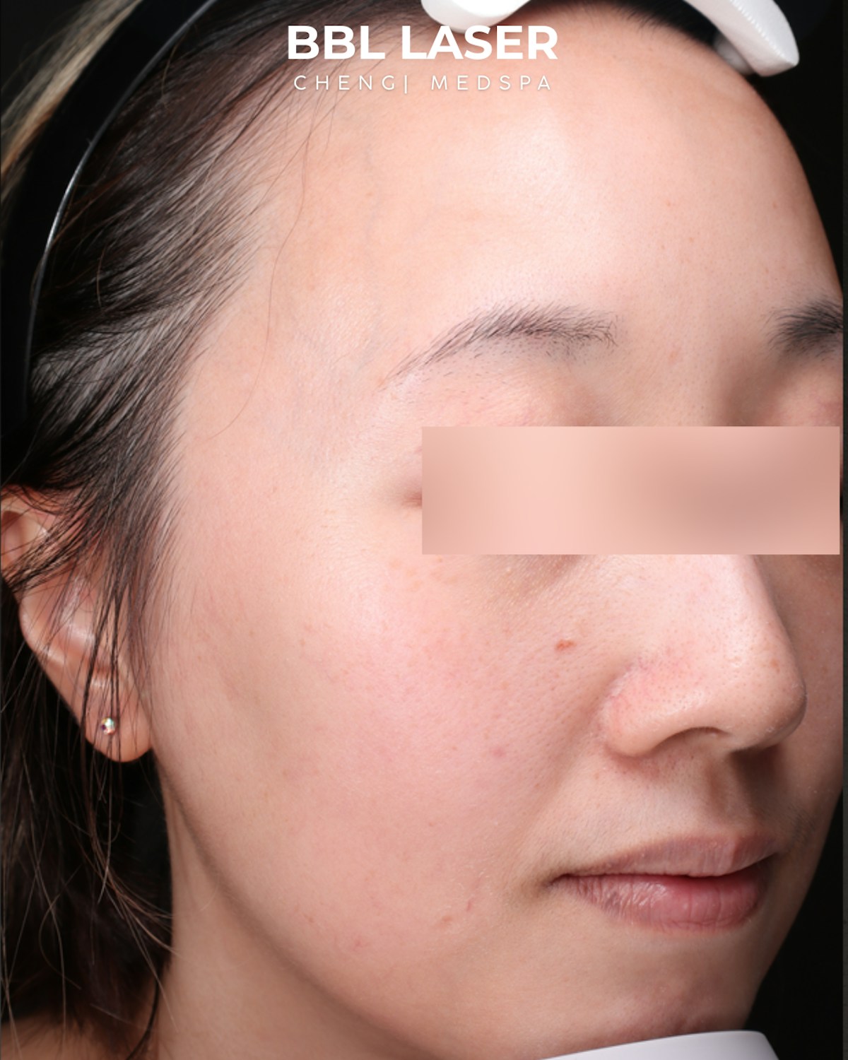 BBL Laser Before & After Gallery - Patient 157854 - Image 3