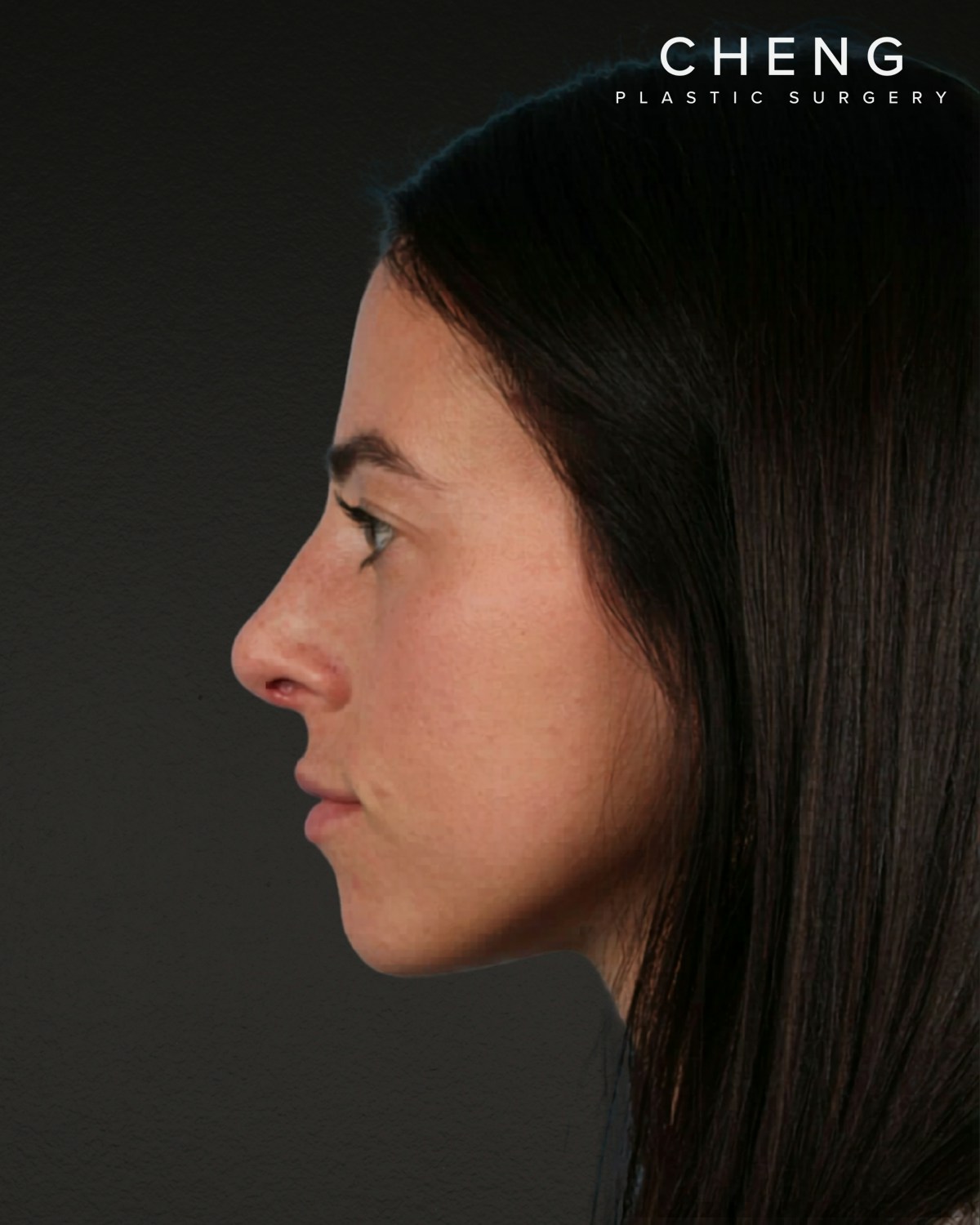 Rhinoplasty Before & After Gallery - Patient 172099 - Image 4