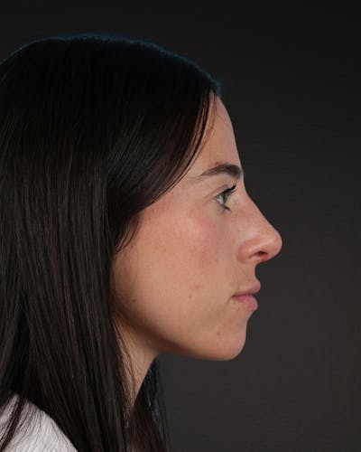 Rhinoplasty Before & After Gallery - Patient 172099 - Image 2