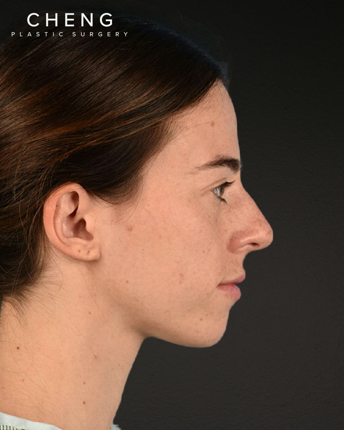 Rhinoplasty Before & After Gallery - Patient 172099 - Image 1