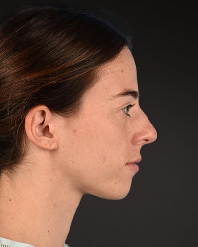 Rhinoplasty Before & After Gallery - Patient 172099 - Image 1