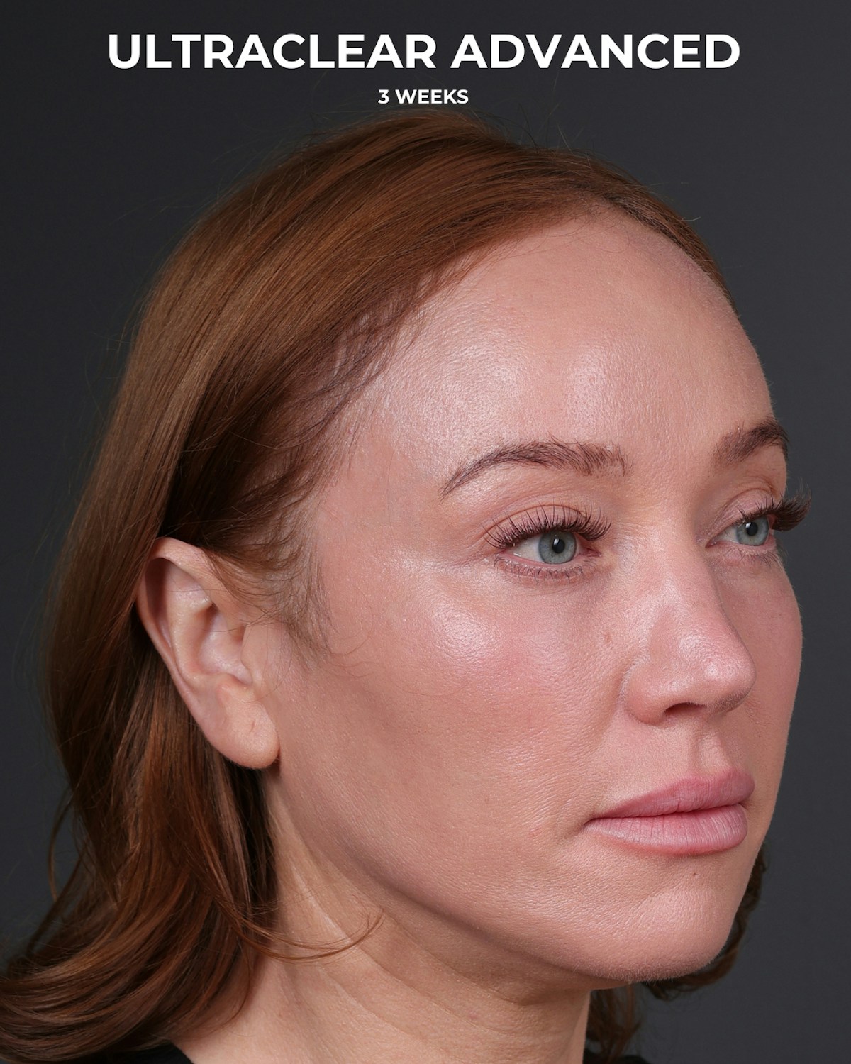 UltraClear Before & After Gallery - Patient 225417 - Image 4