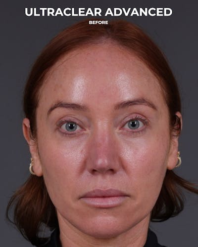 UltraClear Before & After Gallery - Patient 225417 - Image 1