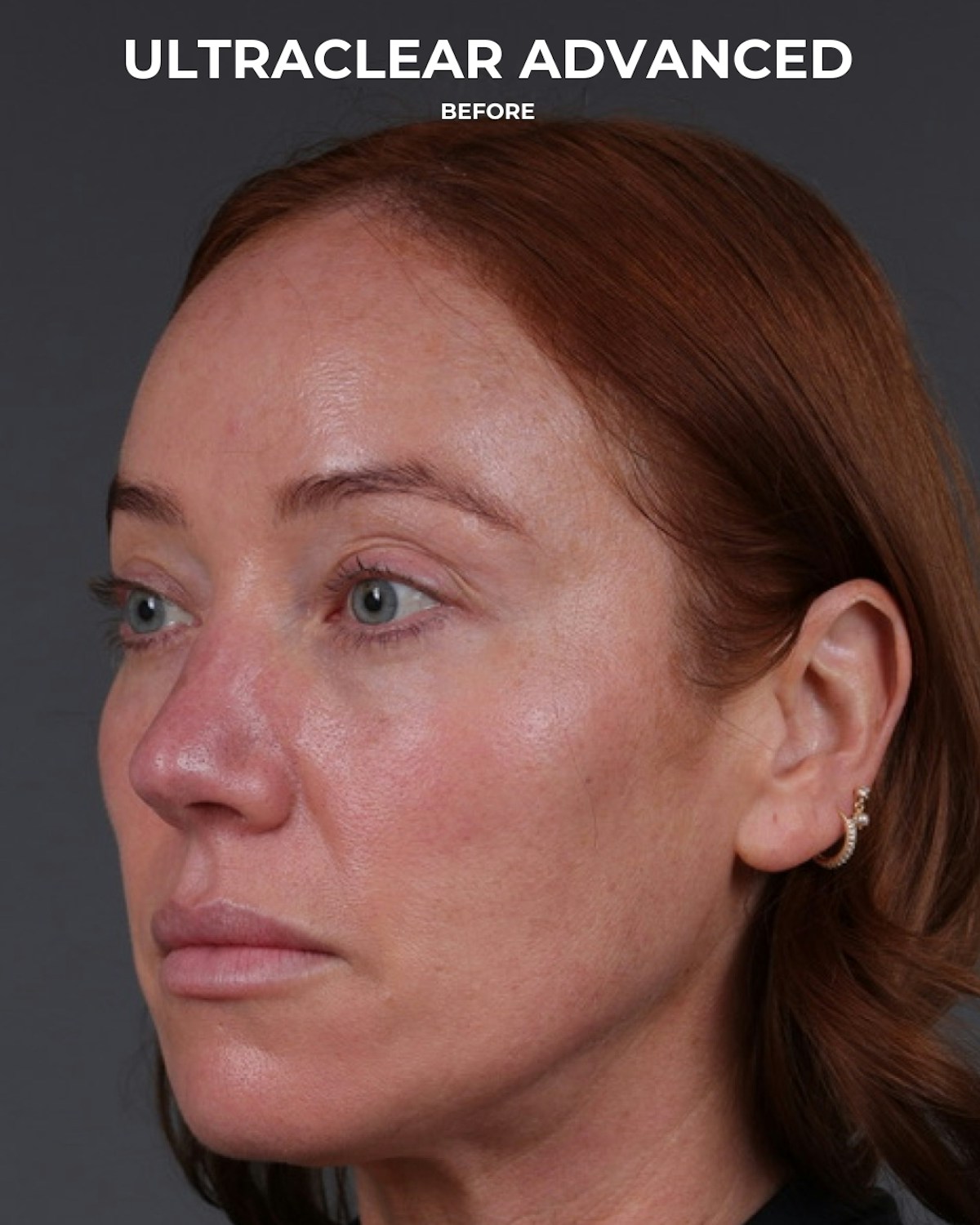 UltraClear Before & After Gallery - Patient 225417 - Image 5