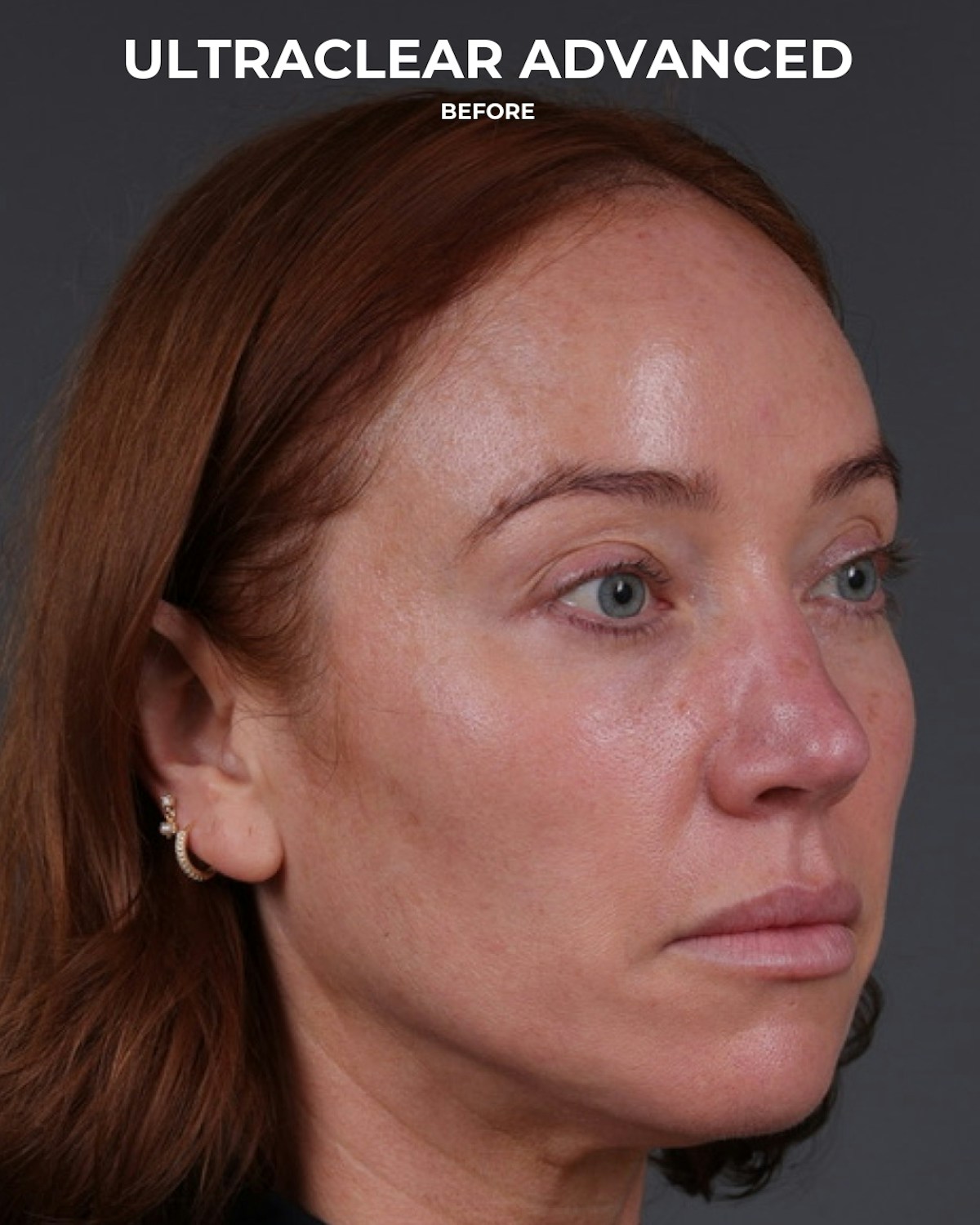 UltraClear Before & After Gallery - Patient 225417 - Image 3
