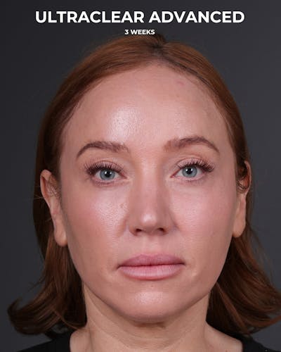 UltraClear Before & After Gallery - Patient 225417 - Image 2