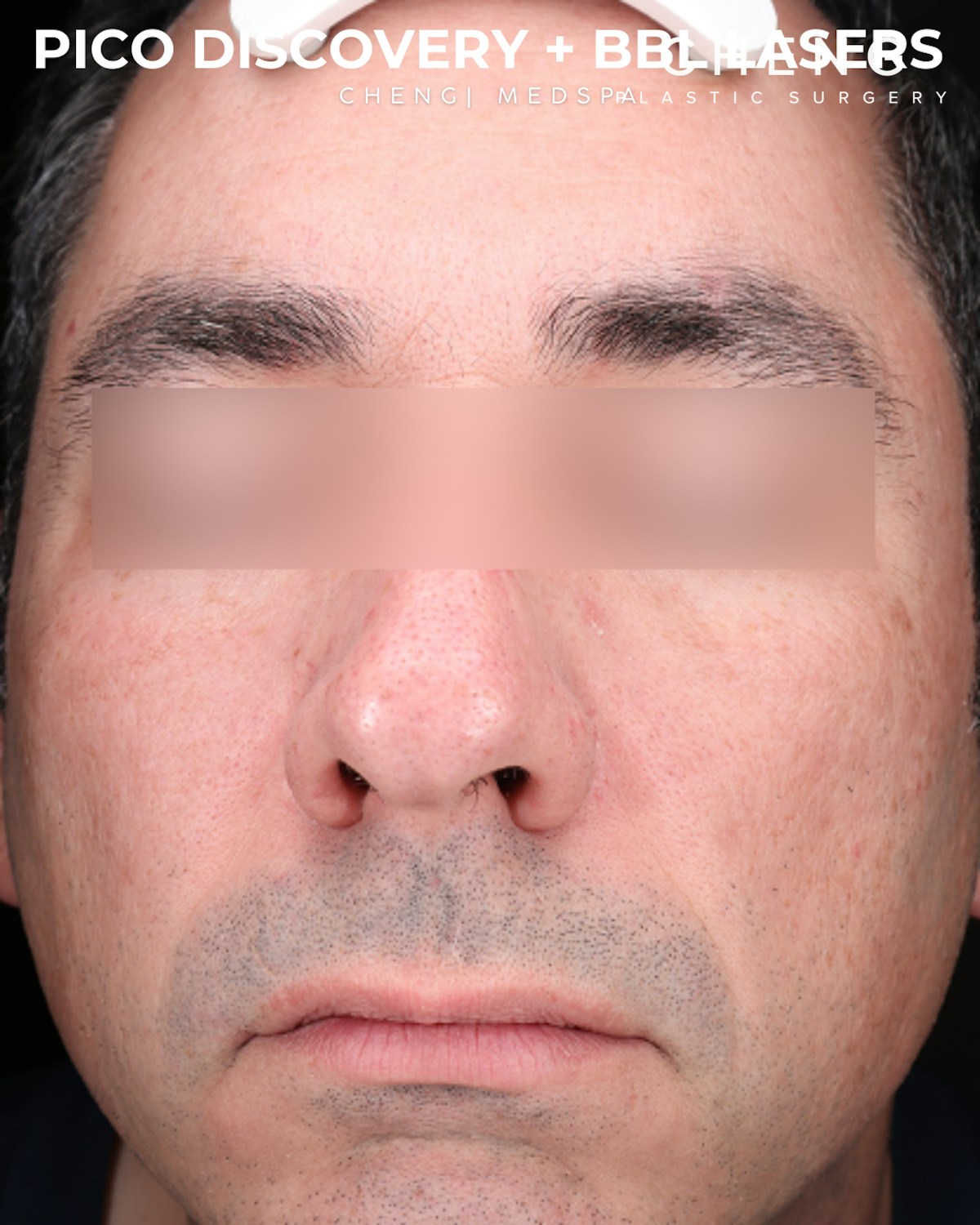 Pigment Laser Before & After Gallery - Patient 304692 - Image 2