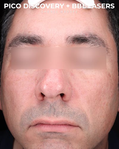 BBL Laser Before & After Gallery - Patient 286352 - Image 2