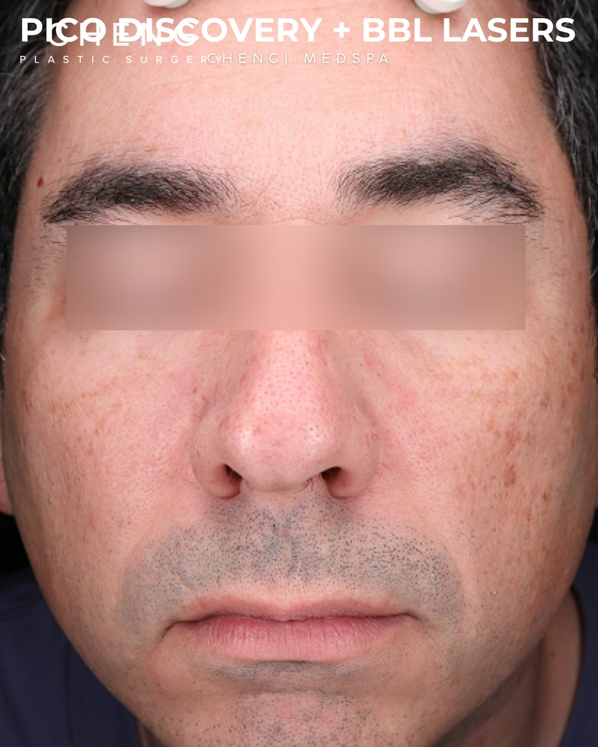 Pigment Laser Before & After Gallery - Patient 304692 - Image 1