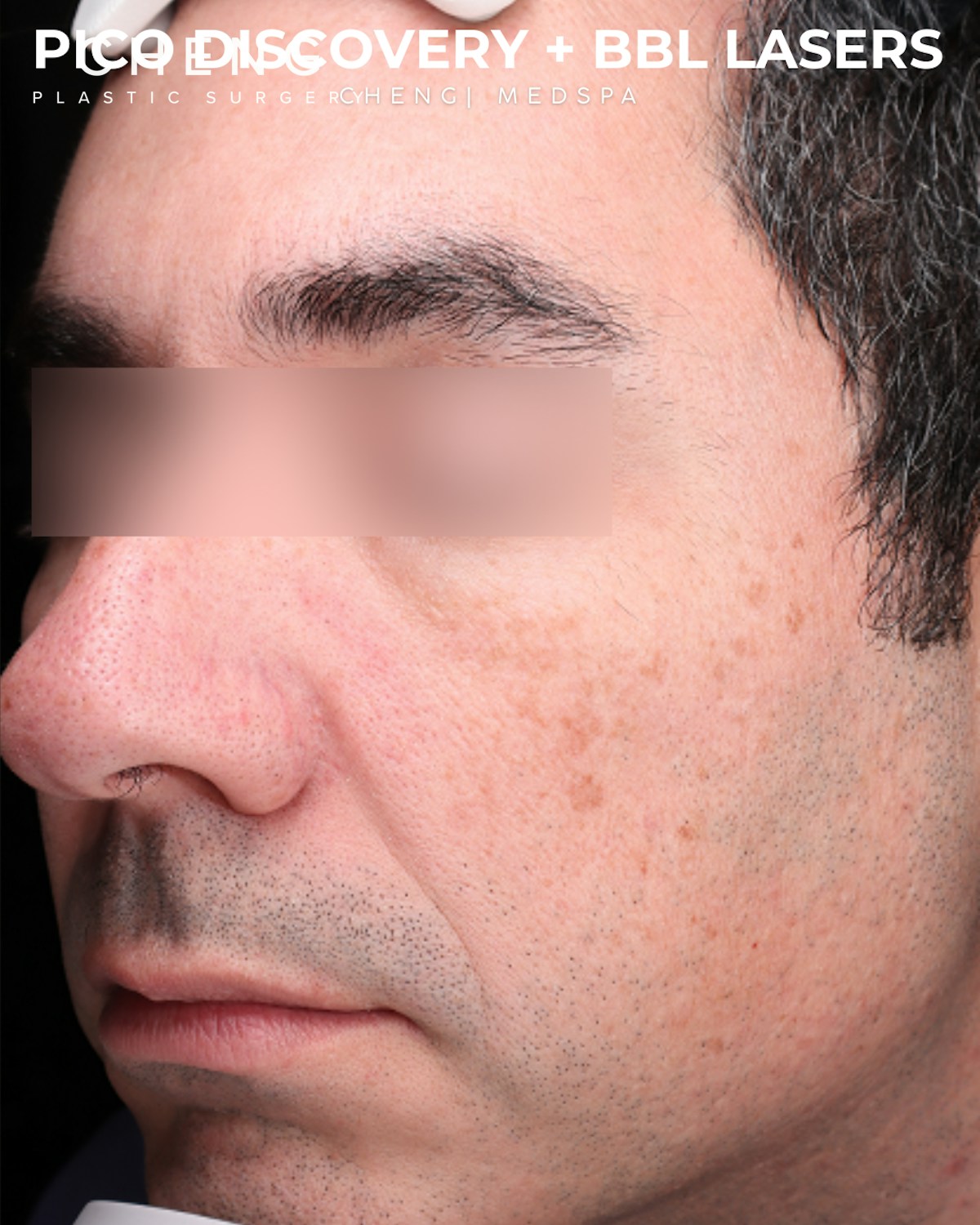 Pigment Laser Before & After Gallery - Patient 304692 - Image 3
