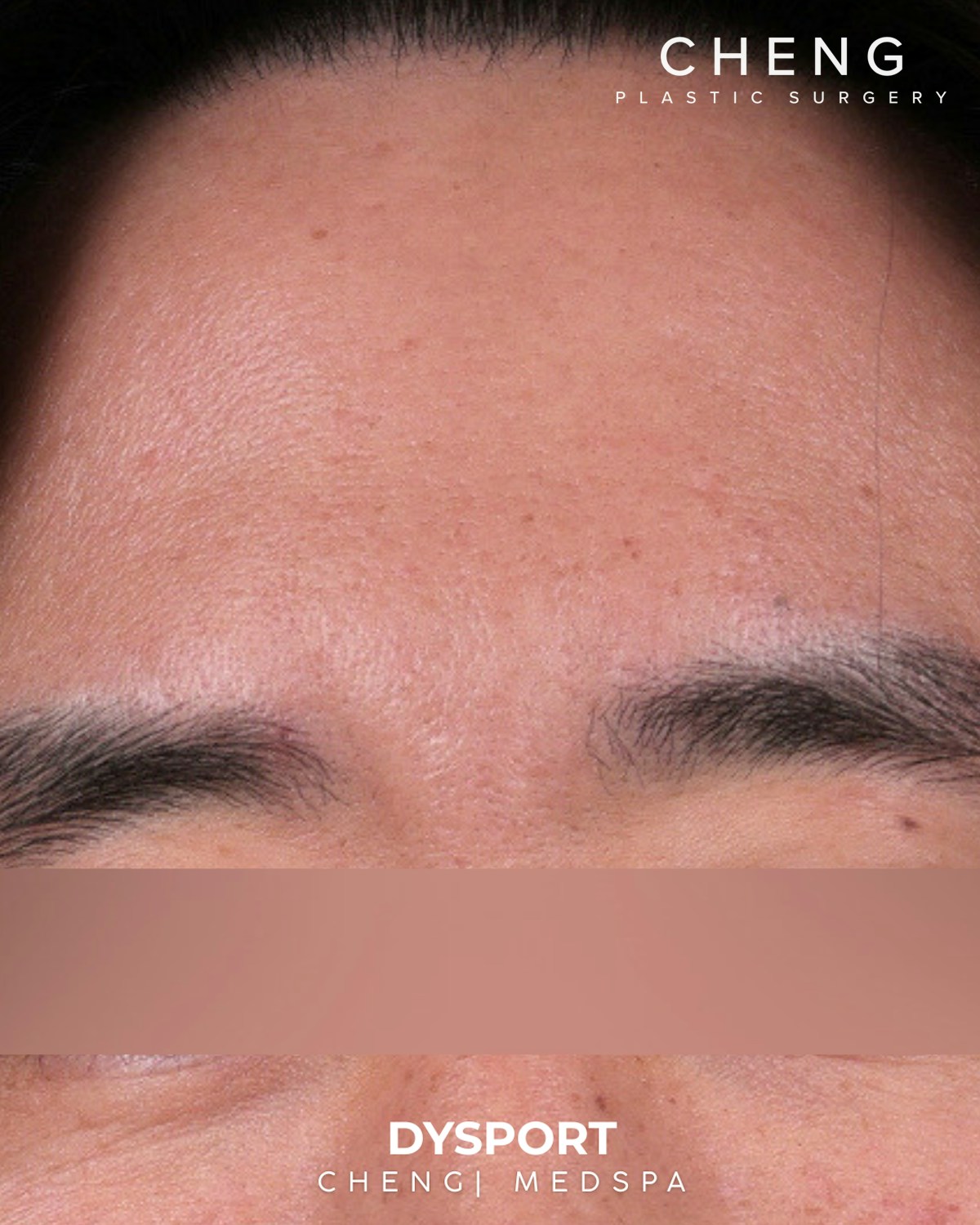 Botox and Dysport Before & After Gallery - Patient 318612 - Image 2