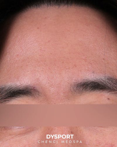 Botox and Dysport Before & After Gallery - Patient 318612 - Image 2