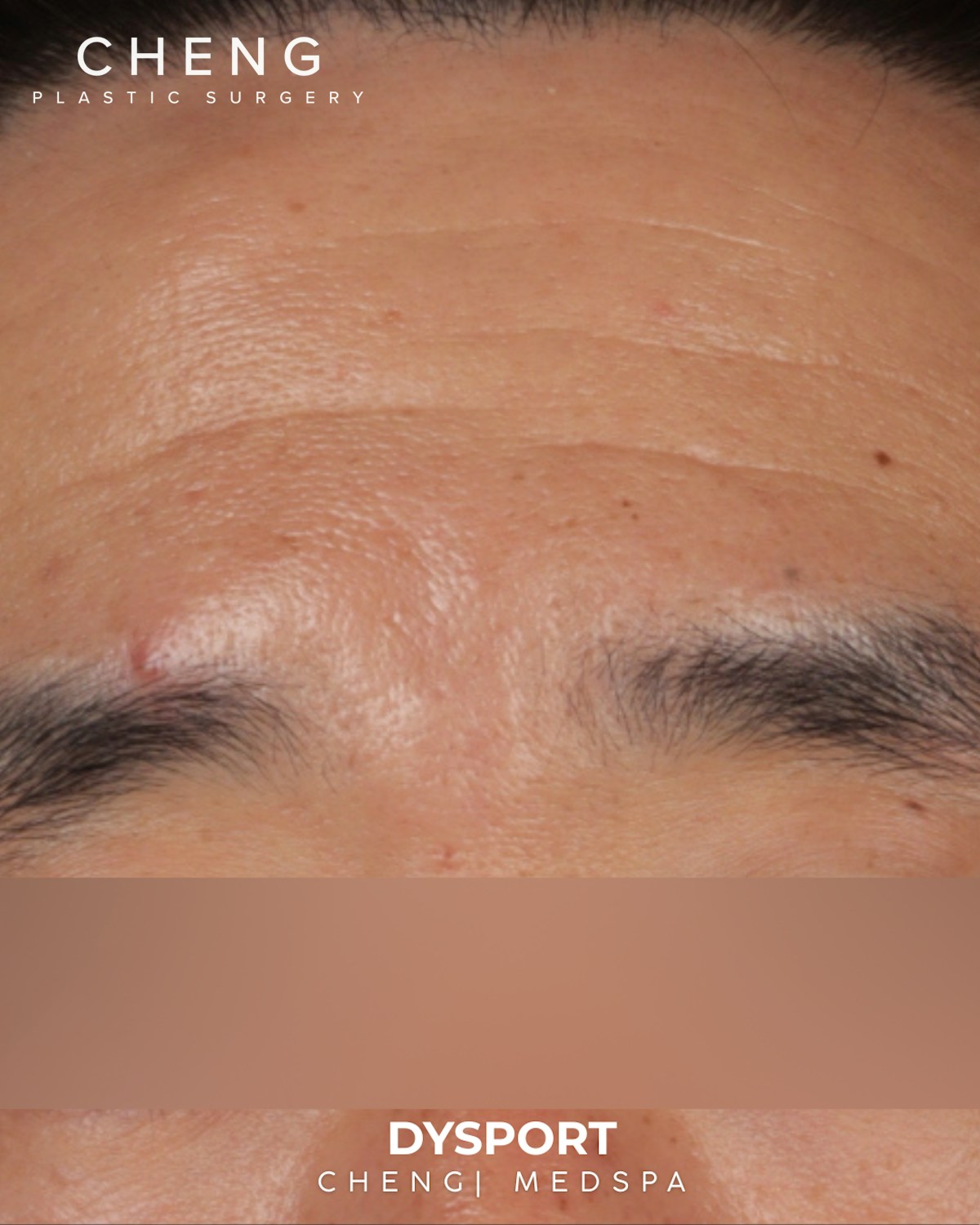Botox and Dysport Before & After Gallery - Patient 318612 - Image 1