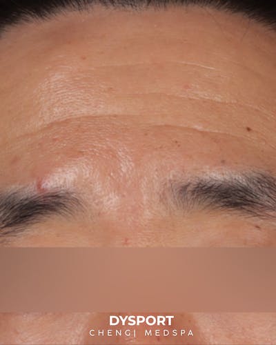 Botox and Dysport Before & After Gallery - Patient 318612 - Image 1