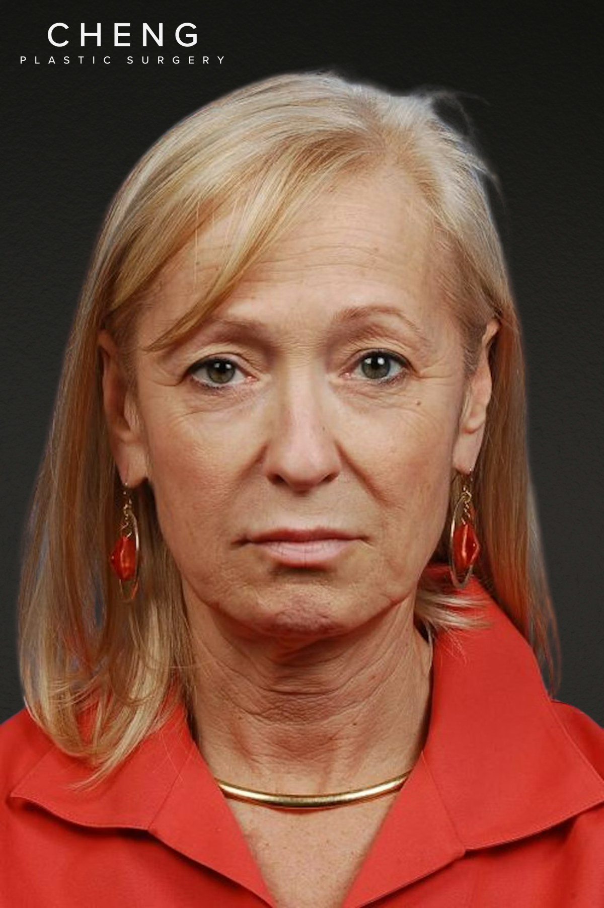Facelift Before & After Gallery - Patient 423612 - Image 1