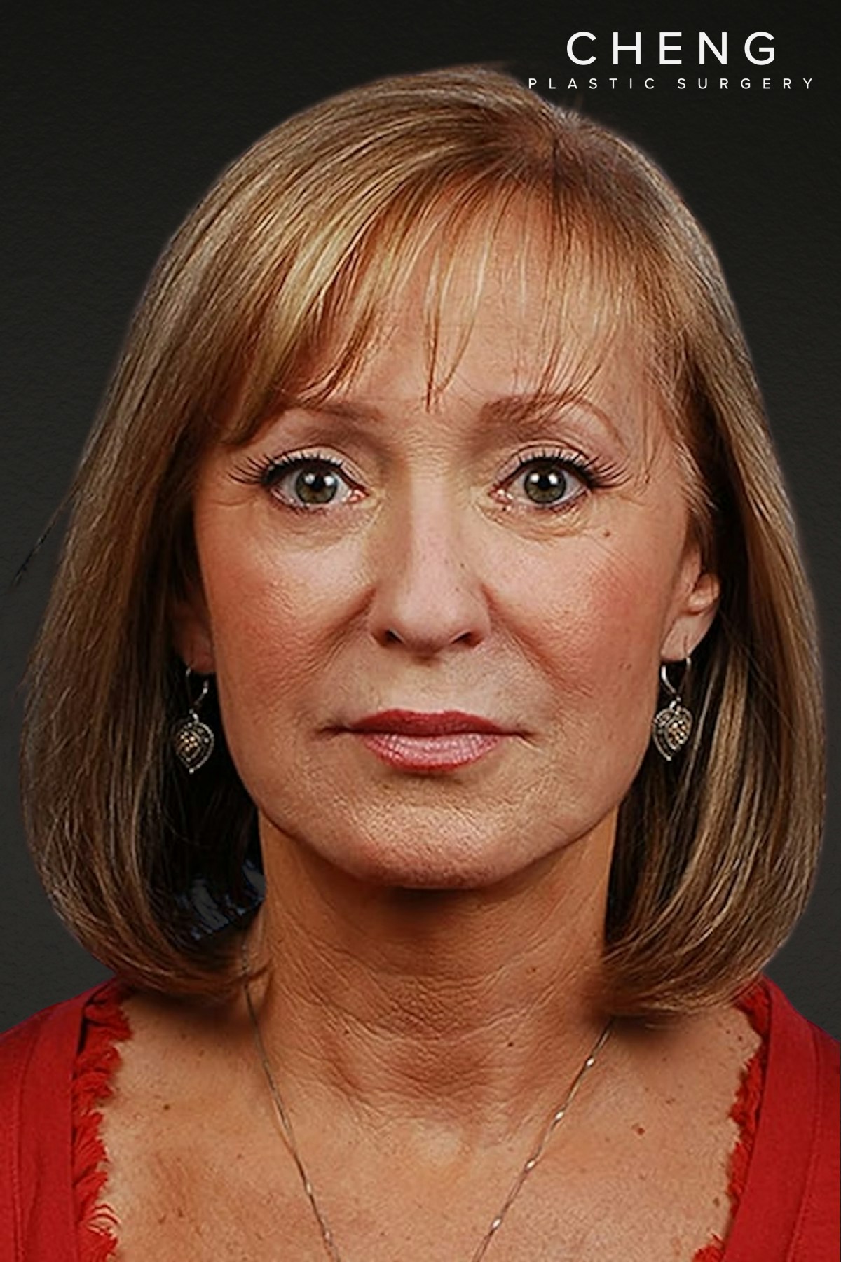 Facelift Before & After Gallery - Patient 423612 - Image 2