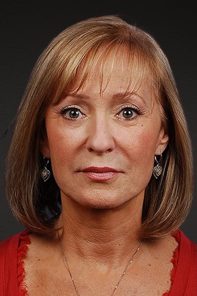 Facelift Before & After Gallery - Patient 423612 - Image 2