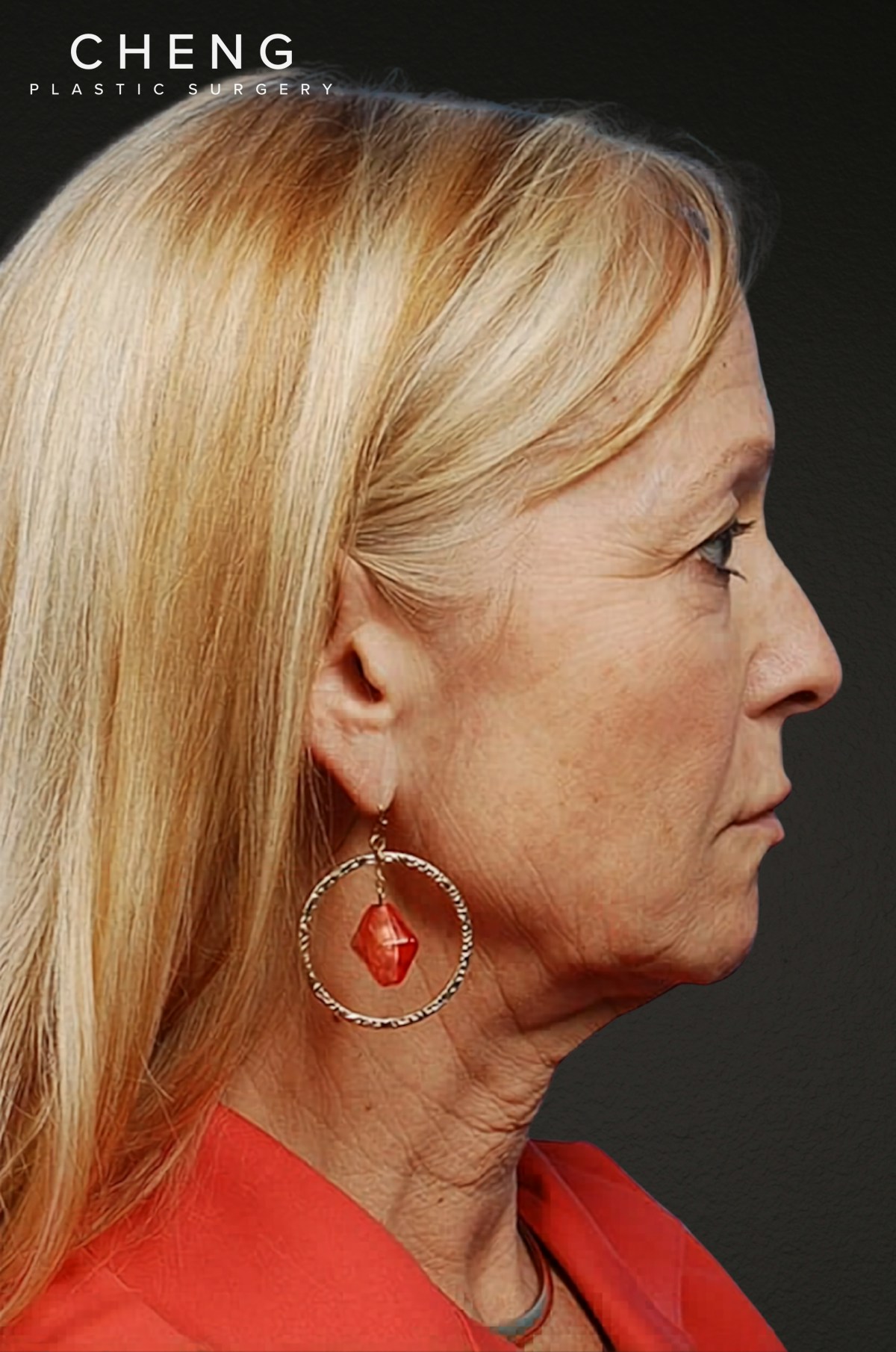 Facelift Before & After Gallery - Patient 423612 - Image 3