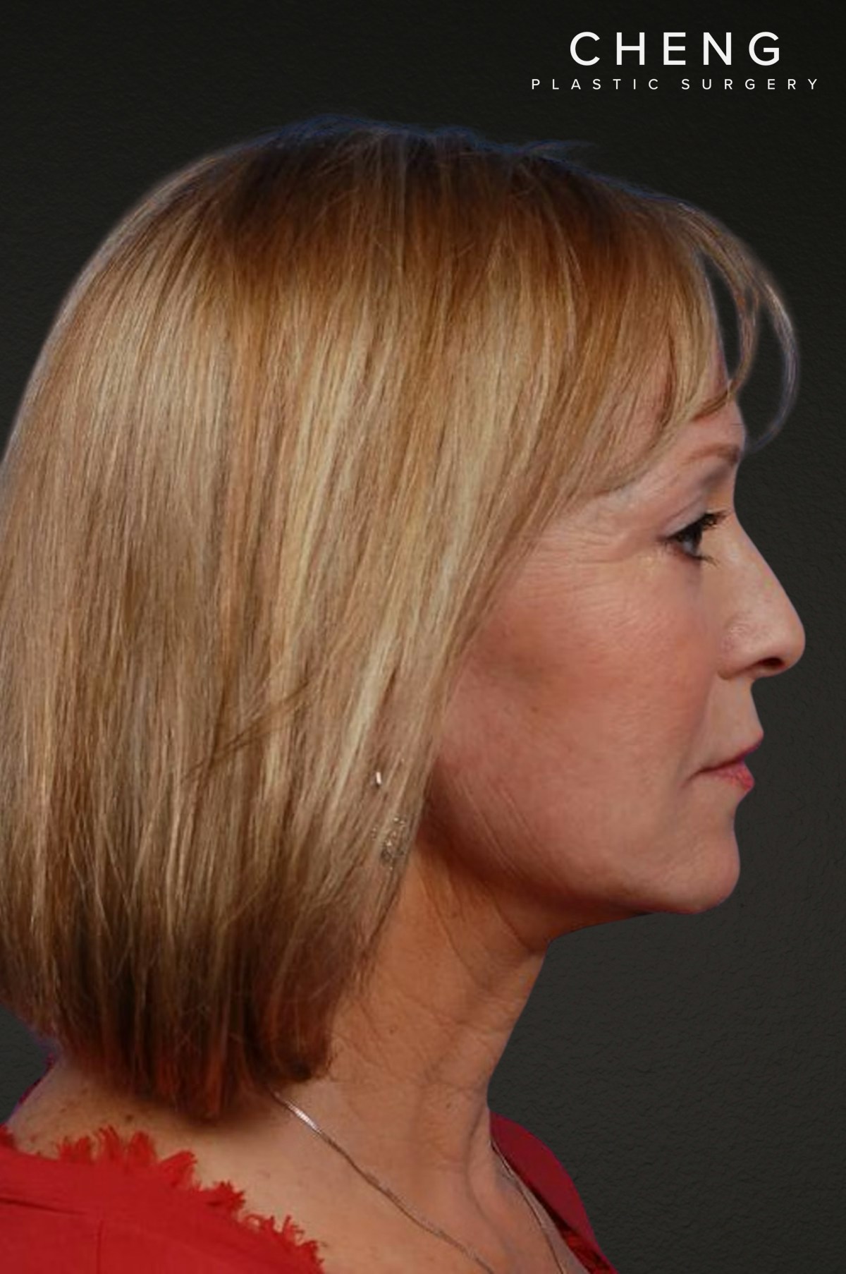 Facelift Before & After Gallery - Patient 423612 - Image 4