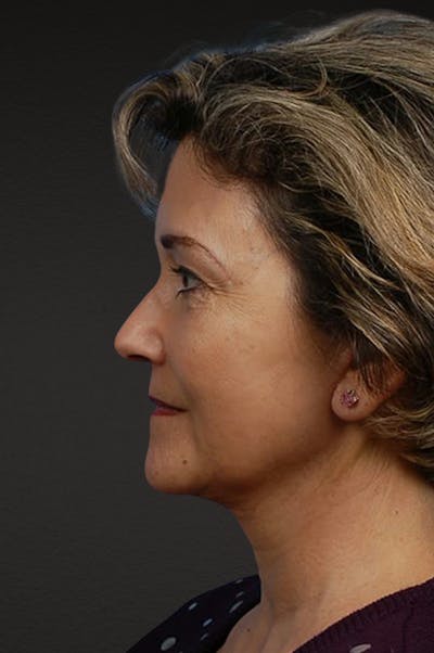 Facelift Before & After Gallery - Patient 976634 - Image 2