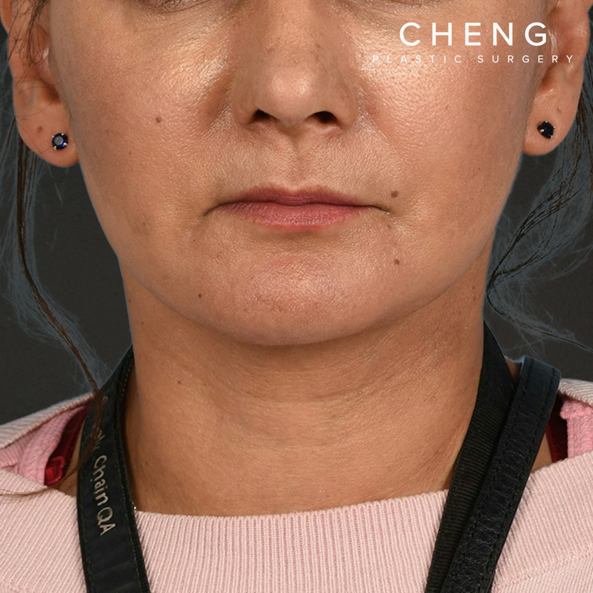 Facelift Before & After Gallery - Patient 230740 - Image 2