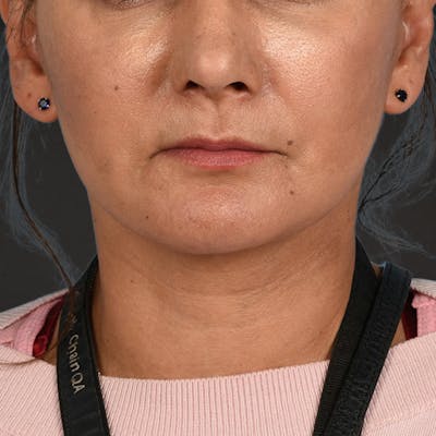 Facelift Before & After Gallery - Patient 230740 - Image 2