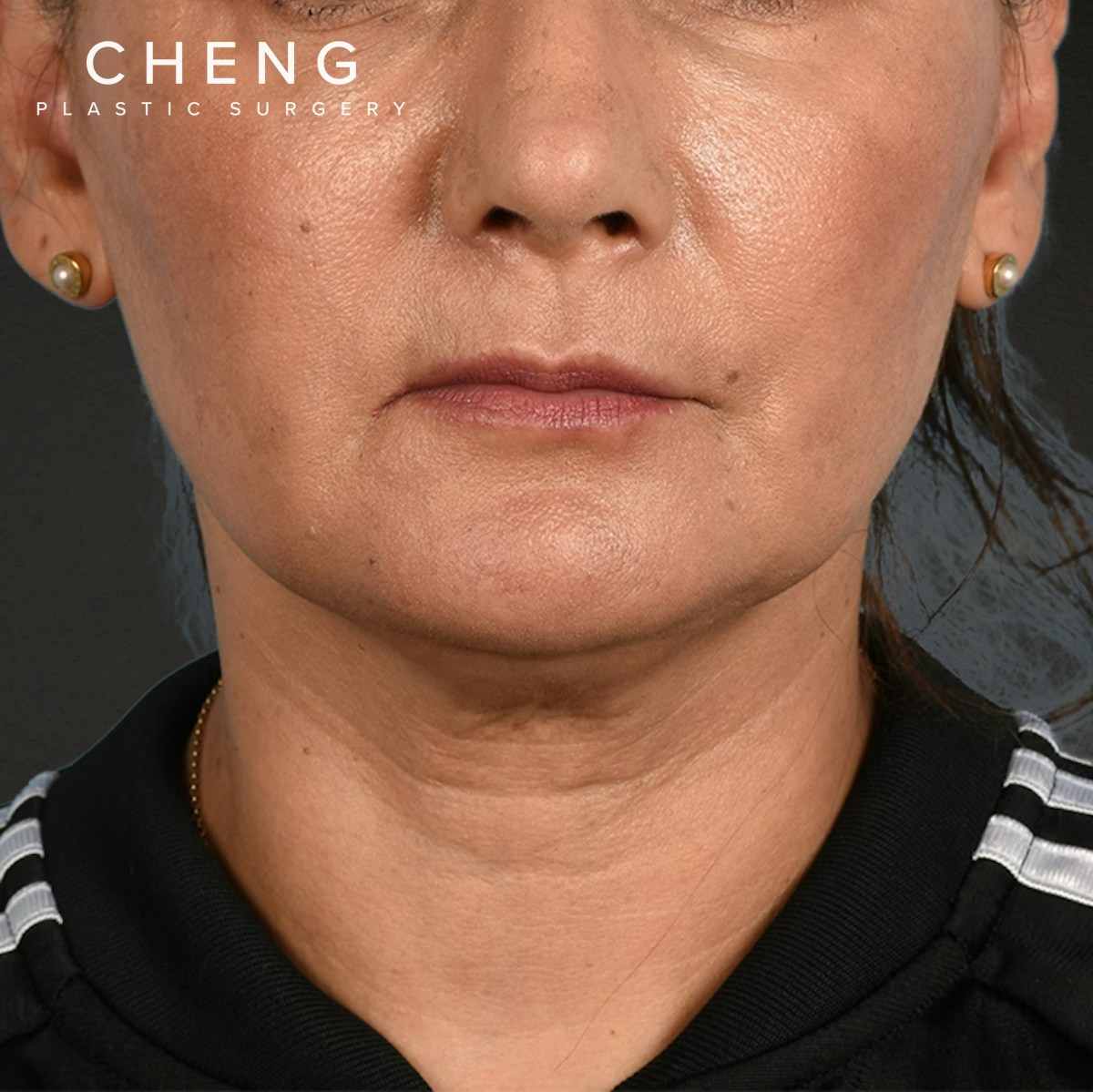 Facelift Before & After Gallery - Patient 230740 - Image 1