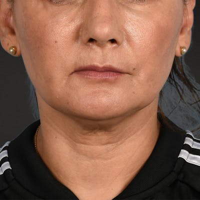 Facelift Before & After Gallery - Patient 230740 - Image 1