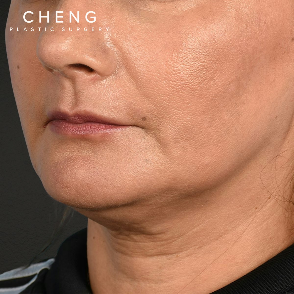 Facelift Before & After Gallery - Patient 230740 - Image 7