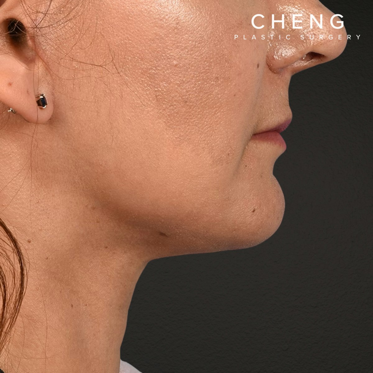 Facelift Before & After Gallery - Patient 230740 - Image 6