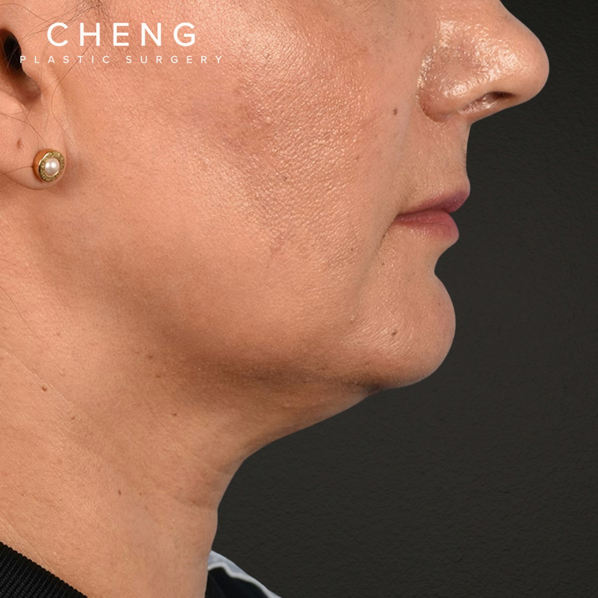 Facelift Before & After Gallery - Patient 230740 - Image 5