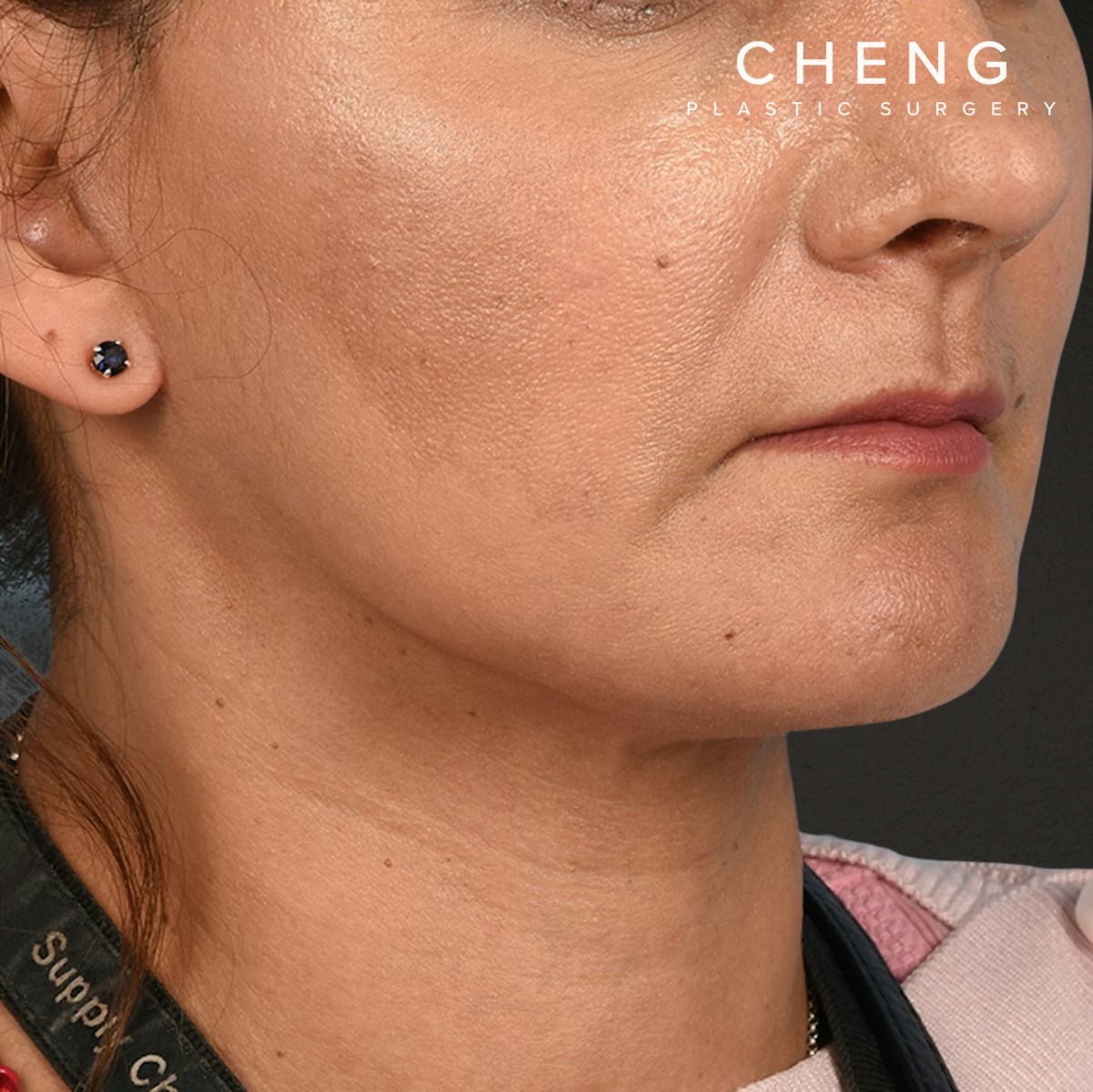 Facelift Before & After Gallery - Patient 230740 - Image 4