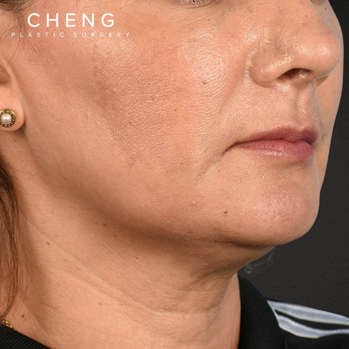 Facelift Before & After Gallery - Patient 230740 - Image 3