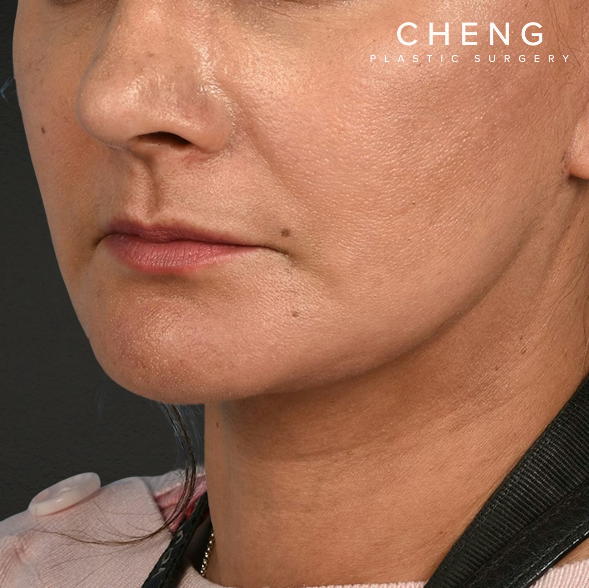 Facelift Before & After Gallery - Patient 230740 - Image 8